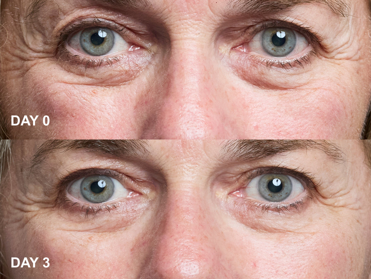 Wrinkles Schminkles blog banner for eye wrinkle patches, a non-invasive alternative to aesthetic treatments for crow's feet and dark circles