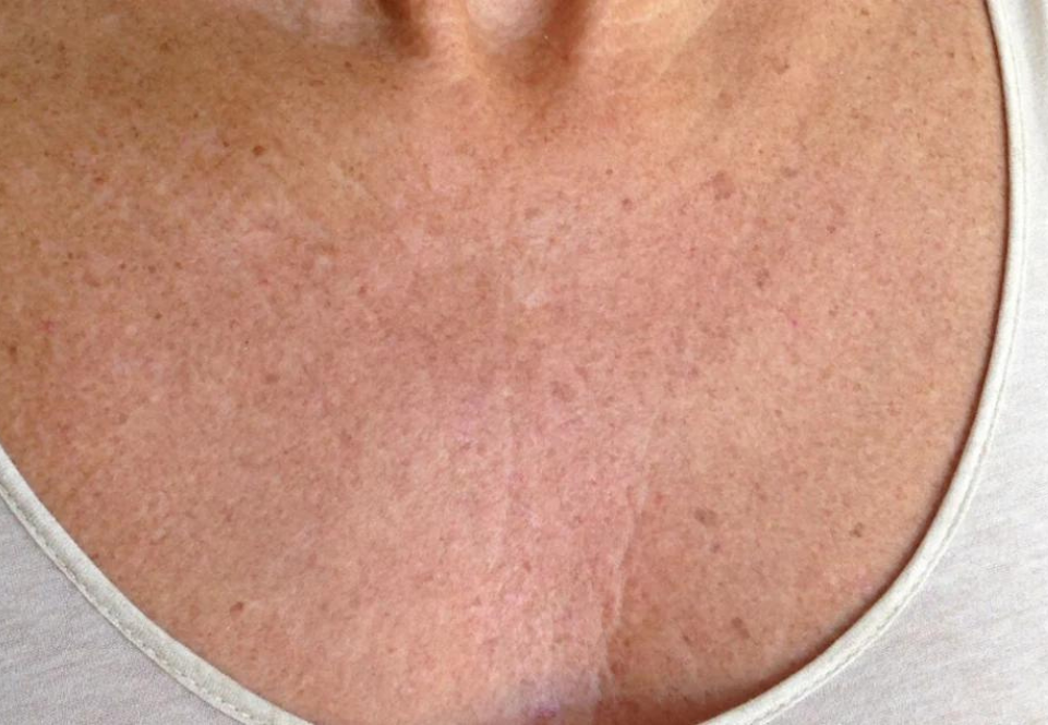 Chest_After