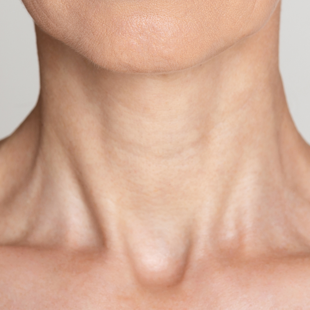 Neck_wrinkles_treatment