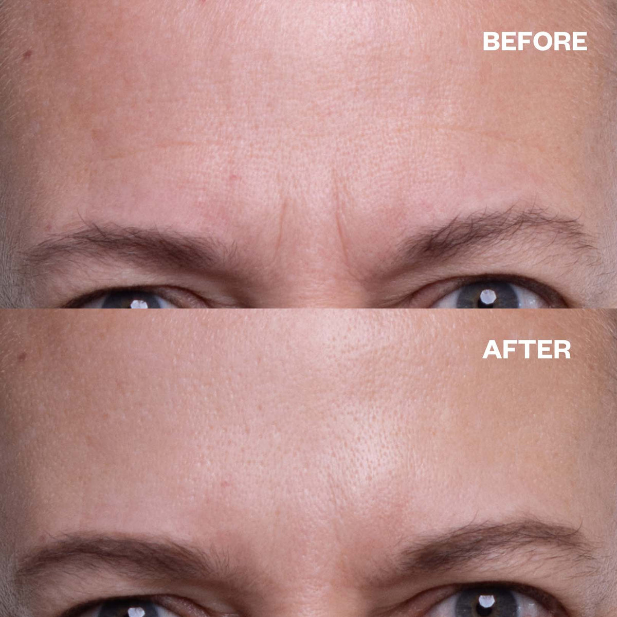 Forehead Wrinkle Patches - 2 Patches - Smooth Forehead and Frown