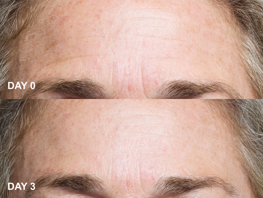 Smooth the Look of Frown Lines Overnight