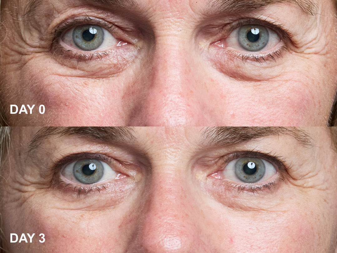 Why Our Patches Are The Best Treatment for Eye Wrinkles