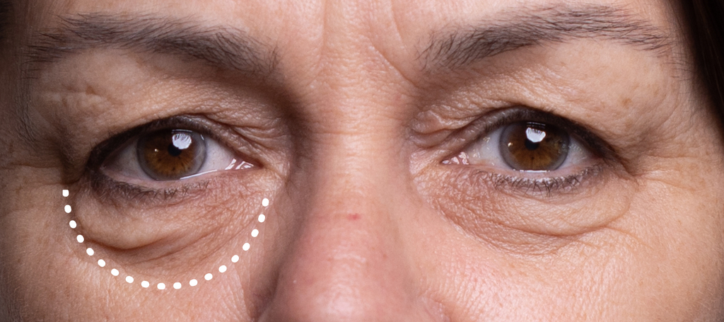 Are You Considering Eye Bag Removal Surgery? <p> First, find out about options the surgeons don't want you to know about!