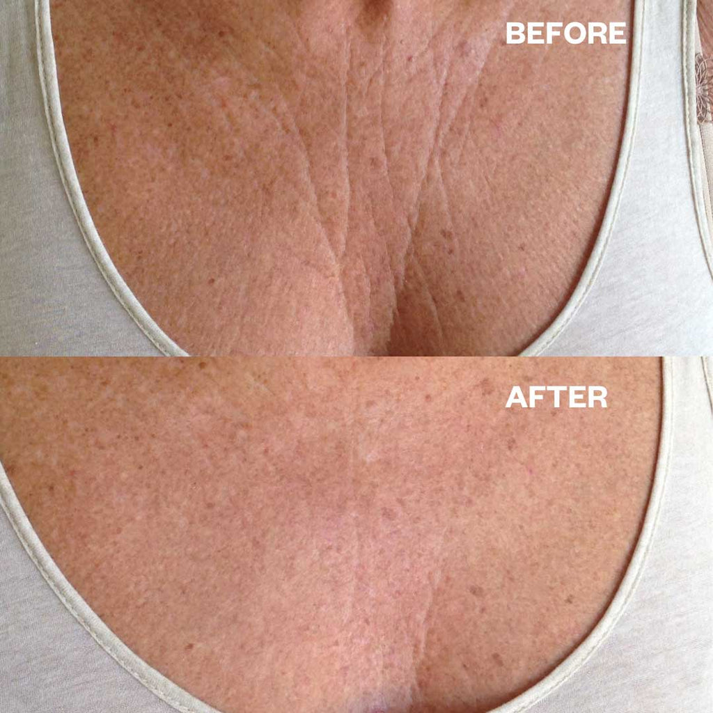 Chest Wrinkle Patch, Smooth Chest, Cleavage and Decolletage Wrinkles