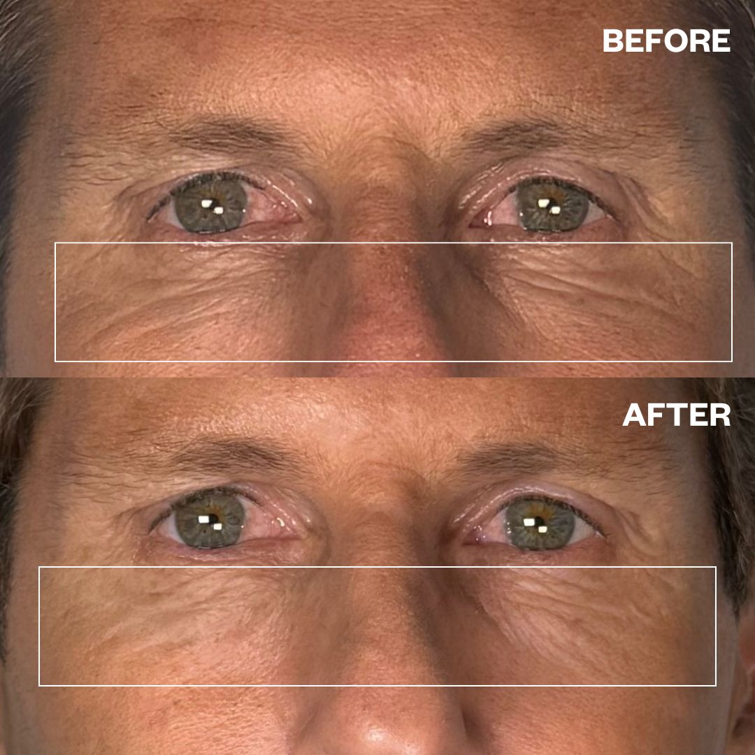 Men's Pro Eye Wrinkle Patches