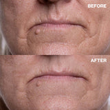 Before and after results using Travel Minis Bundle for marionette lines and lip lines