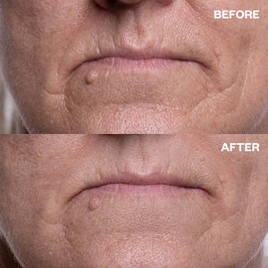 Before and after results using Travel Minis Bundle for marionette lines and lip lines