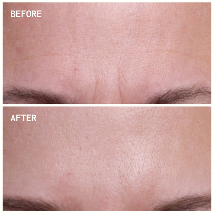 Forehead Wrinkles | Trial Patch