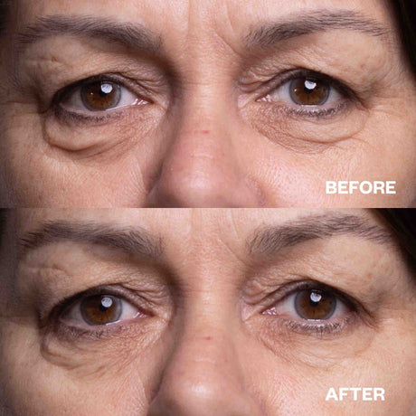 Before and after results using Travel Minis Bundle for crow's feet and under-eye wrinkles