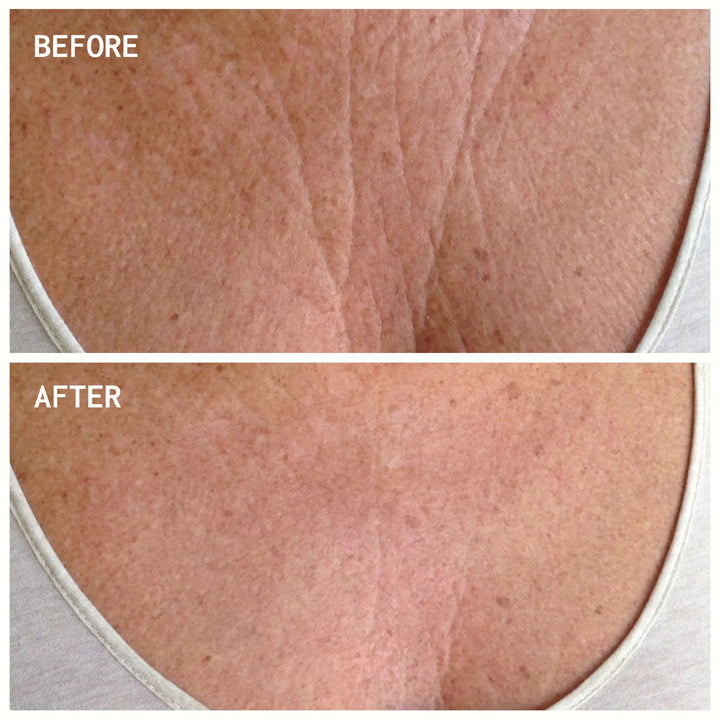 Chest Wrinkle Patches